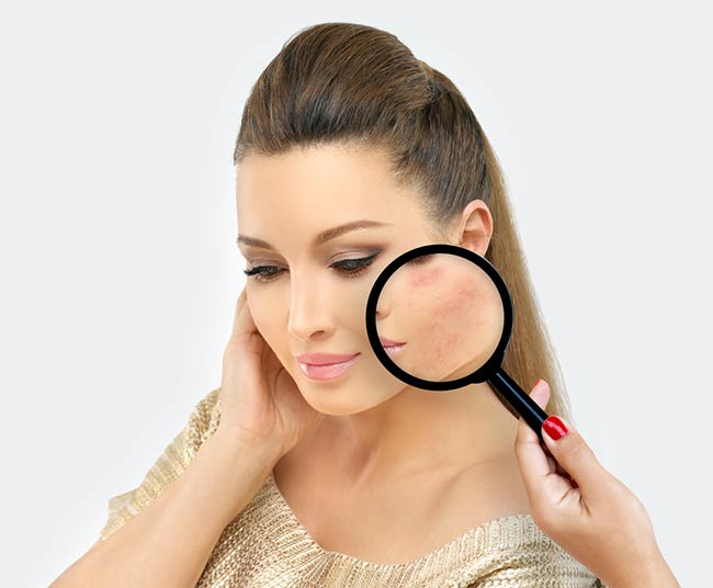 How to remove acne scars in few days.